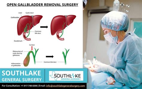 Gallbladder removal